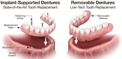 The Pros and Cons of Implant Dentures - Beautiful Smiles - Dental & Denture Care