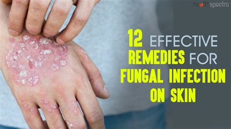12 Effective Remedies For Fungal Infection On Skin | Healthspectra - YouTube