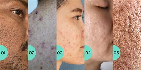 Everything You Need To Know About Acne Scarring - SkinLab