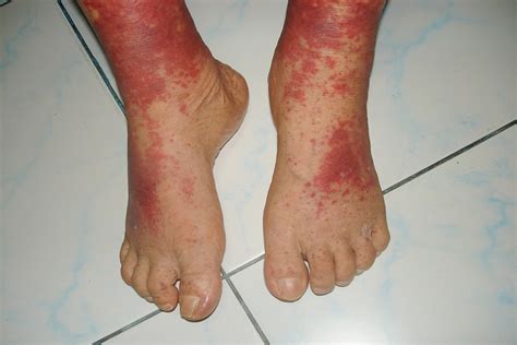 What Is Vasculitis? Symptoms, Causes, & Treatment