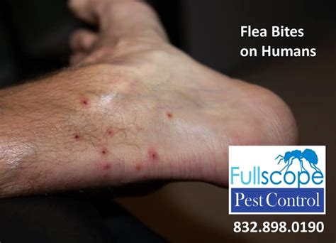 Flea Bites on Humans - FullScope Pest Control