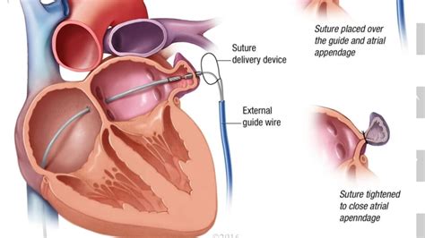 Leaks after percutaneous left atrial appendage occlusion and stroke risk - Mayo Clinic