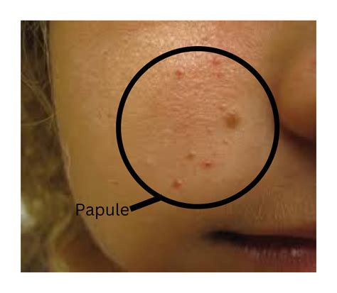 Fibrous Papule On Nose | Causes, Diagnosis, And Treatments