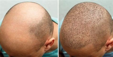 5 Reasons Scalp Micropigmentation is Trending | Zang SMP