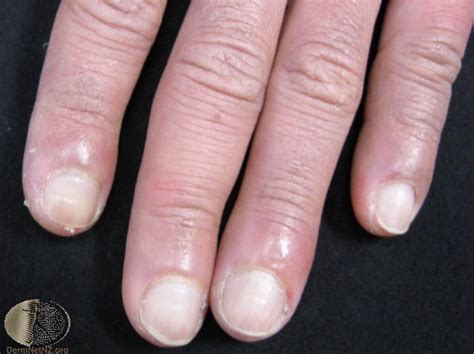 87 best images about Clinical Diagnosis on Pinterest | Signs, Nail bed and Lupus pernio