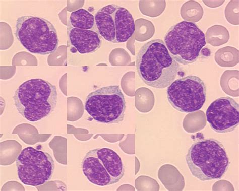 Mantle cell lymphoma