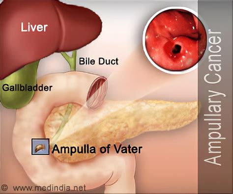 Ampullary Cancer Causes Symptoms Diagnosis Treatment