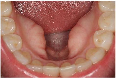 Torus Mandibular | Odontología al Dia