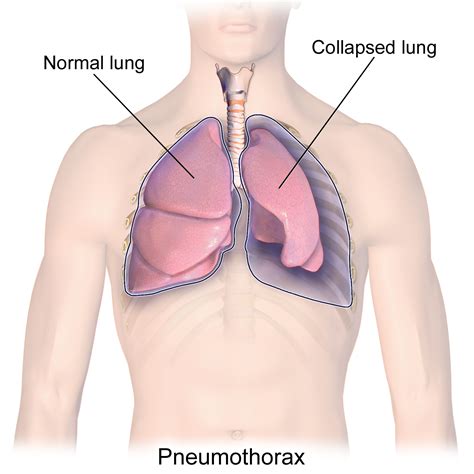 Condition Specific Radiology: Pneumothorax - Stepwards