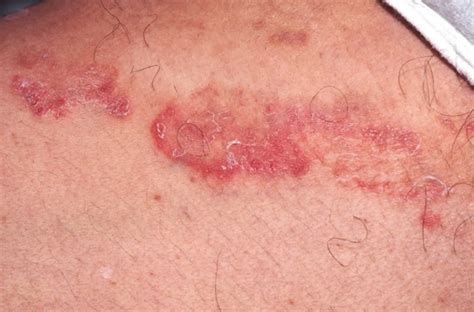 Tinea cruris definition, causes, symptoms & over the counter treatment