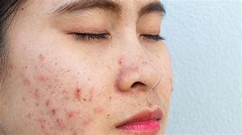 What Causes Red Spots on Skin? Dermatologists Explain, red spats - plantecuador.com