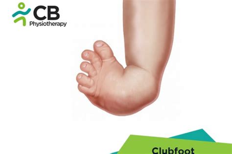 What is Clubfoot or Congenital Talipes Equinovarus or CTEV? Symptoms, Causes, Diagnosis ...