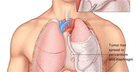 Pleurectomy Decortication Is Effective Handling For Mesothelioma Cancer - Mesothelioma