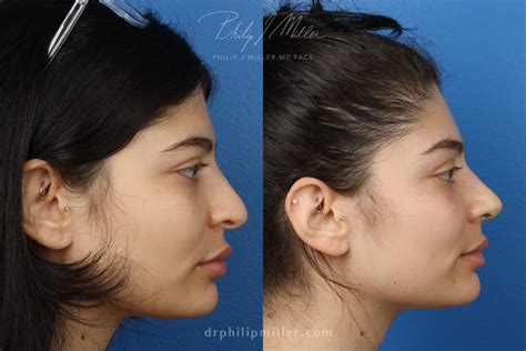 Your Most Beautiful Nose: Understanding Your Nose Type - Philip Miller MD