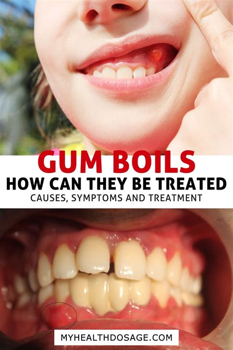 how to get rid of gum abscess fast - Dishy Microblog Gallery Of Photos