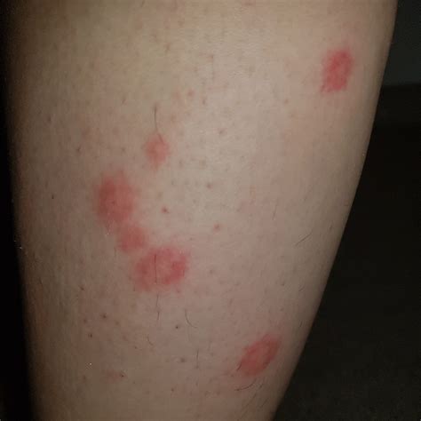 Bed Bug Bites Symptoms Time