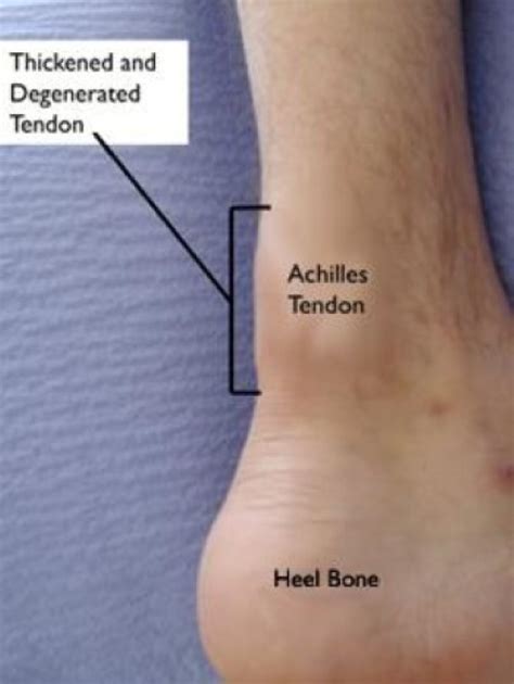 Tendonitis