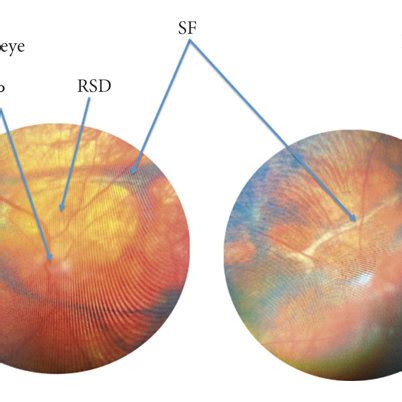 Fundus photograph showing papillitis (P) with blurred optic disc ...