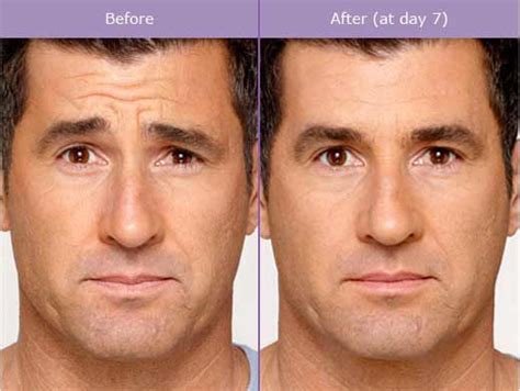 Botox Helps Remove Wrinkles | Dallas, Plano, Fort Worth, Grapevine TX