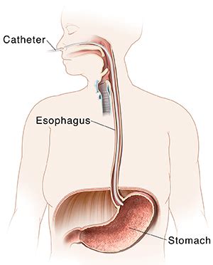 Esophageal Manometry | Saint Luke's Health System