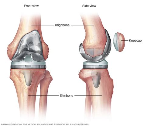 Inmuebles Referéndum hipótesis retiro de protesis de rodilla infectada Pompeya ir al trabajo Decorar