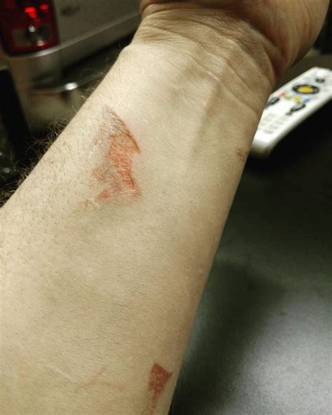 Welding Burns on Skin: How to Protect Yourself (Updated: August 2024)