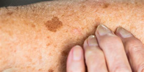 Skin Sunspots (Aka Age Spots): Causes, Prevention, and How to Get Rid ...