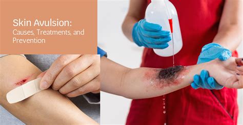 Skin Avulsion: Causes, Treatments, and Prevention | Clinikally