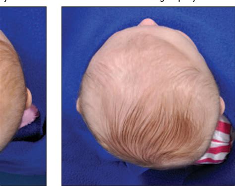 Positional Plagiocephaly