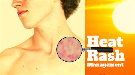 Heat Rash (Miliaria) – Causes and Management | Tibot