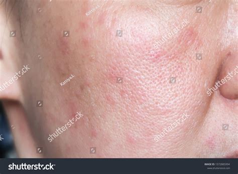 Allergy Rash On Woman Face Stock Photo 1572885994 | Shutterstock