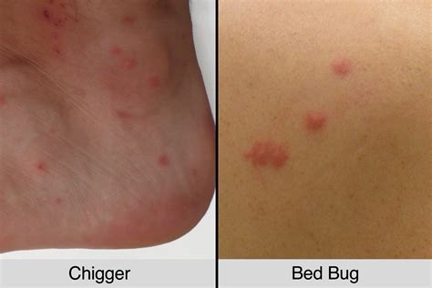 Flea Bites Vs Bed Bug Bites | Renew Physical Therapy