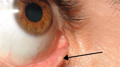 There's A Little Hole In Your Eyelid That You Probably Never Noticed. What's It For? | IFLScience