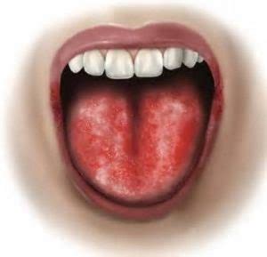 5 Common Causes of Burning Tongue | UTOdent.con