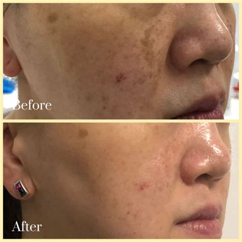 PicoWay Laser Sydney | Quick Pigmentation & Tattoo Removal Treatment