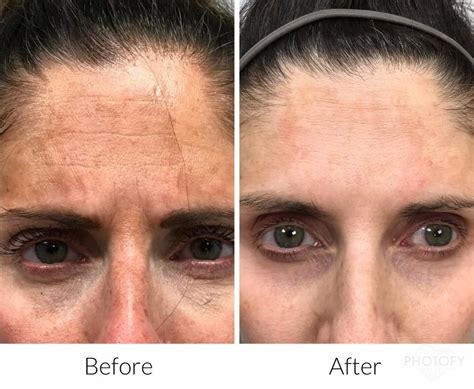 Chemical Peels | Manchester, NH | Pellé Medical Spa