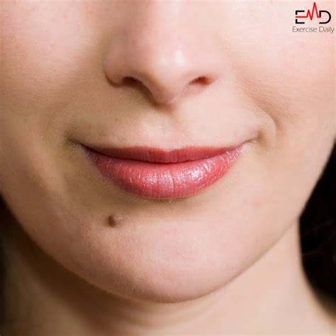 White Bumps on Lips - Causes and Management