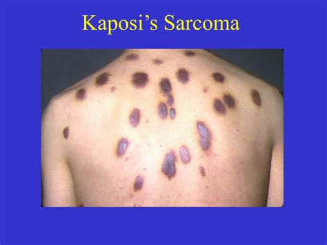 Kaposi Sarcoma Early Signs