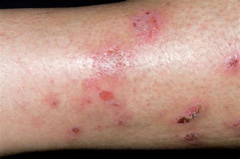 Spongiotic Dermatitis On The Leg Photograph by Dr P. Marazzi/science Photo Library