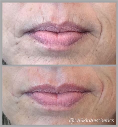 Smoker lines correction: One syringe of #Volbella was injected into ...