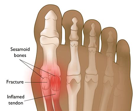 Sesamoiditis and Sesamoid Fracture - OrthoInfo - AAOS