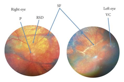 Fundus photograph showing papillitis (P) with blurred optic disc ...