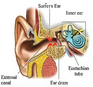 Ear exostosis (surfer's ear)