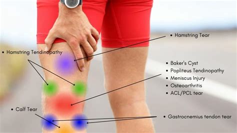 Knee Pain Location Chart | Learn the Pain Location of Knee Injuries