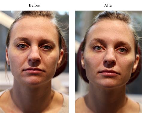 JUVEDERMXCBEFOREAFTERNASOLABIALFOLDS Dr. Beth Comeau MD