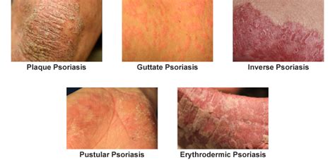 Guttate psoriasis scars