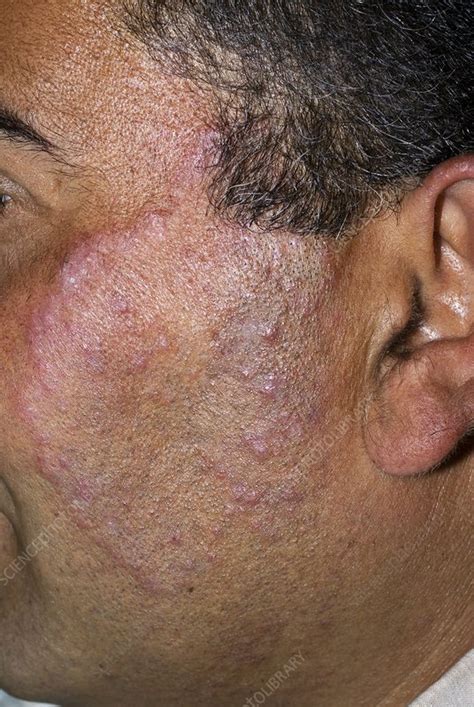 Tinea fungal infection on the face - Stock Image - C010/3378 - Science Photo Library