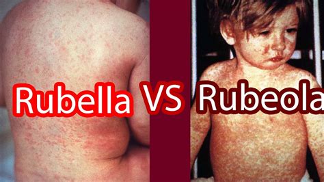 Rubella vs Rubeola (Measles vs German Measles) - YouTube