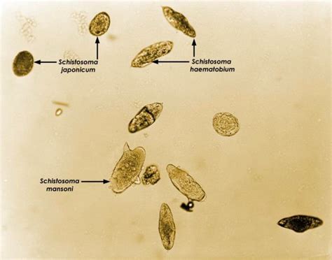 Schistosoma Haematobium