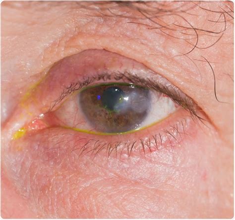 Herpes Simplex Keratitis